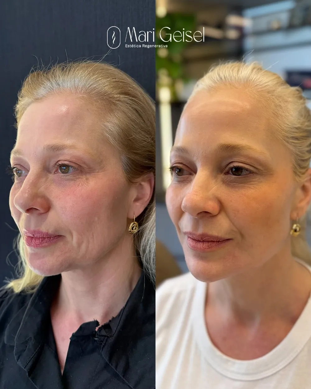 Antes e depois de harmonização facial natural com o Protocolo Légère
