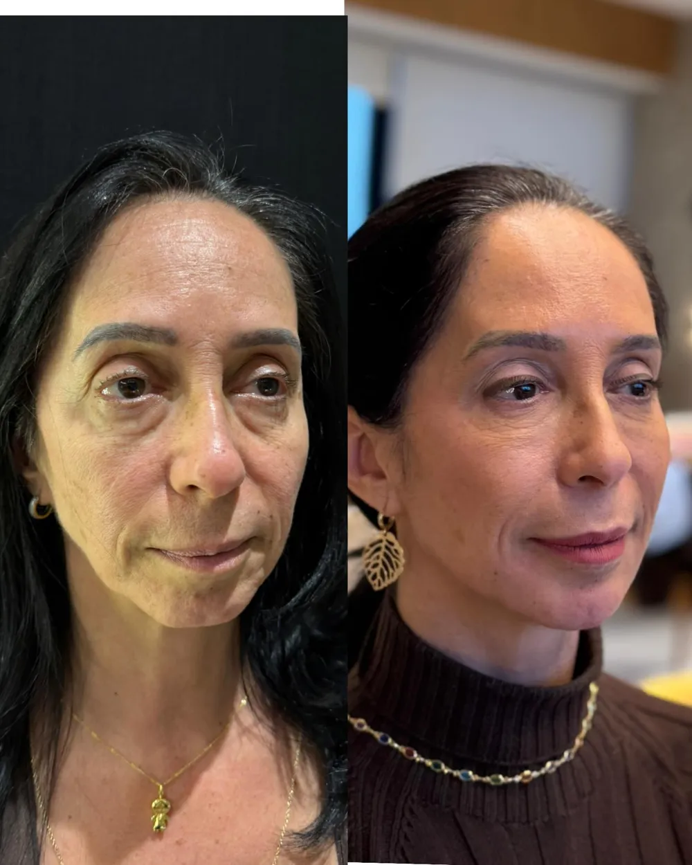 Antes e depois de rejuvenescimento facial com a Dra. Mari Geisel