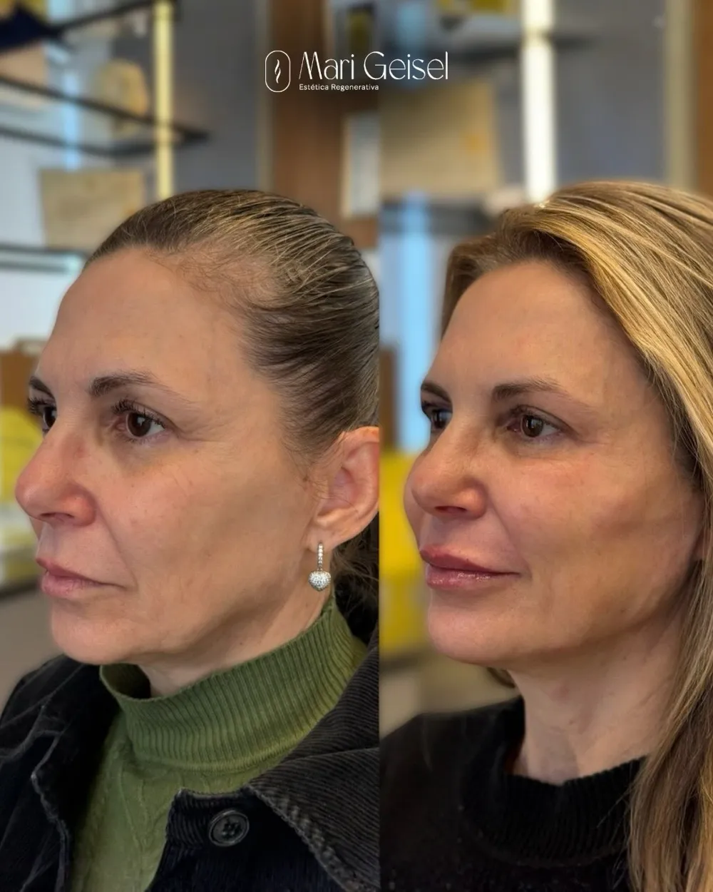 Antes e depois de contorno mandibular com a Dra. Mari Geisel em Canoas
