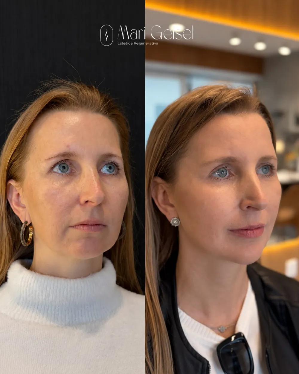 Antes e depois de firmeza natural com a Dra. Mari Geisel em Canoas