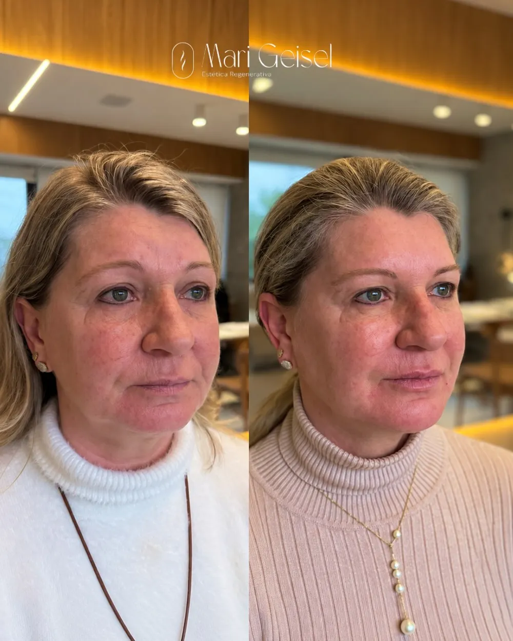 Antes e depois de qualidade da pele com a Dra. Mari Geisel em Canoas