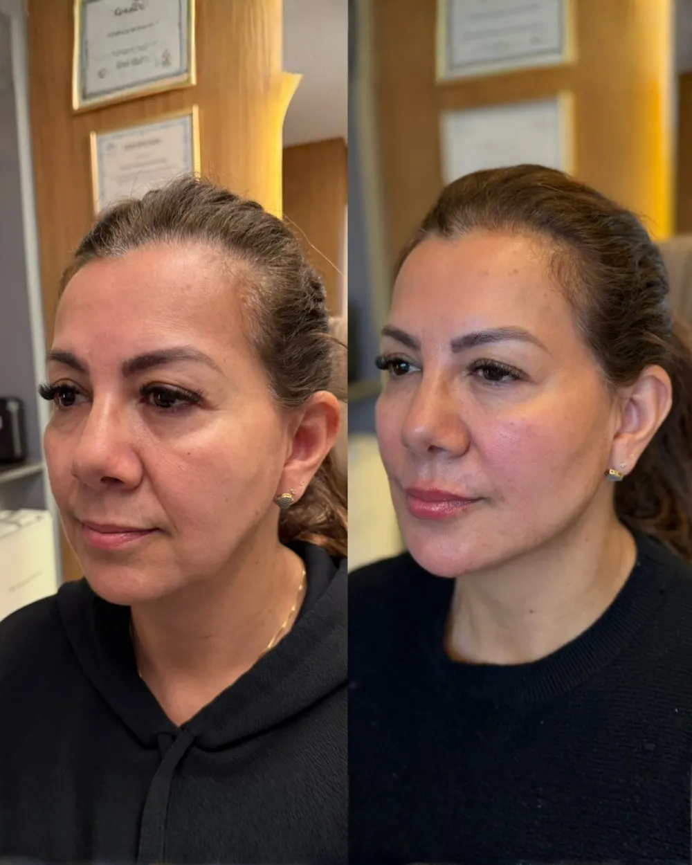 Antes e depois de terço inferior com a Dra. Mari Geisel em Canoas
